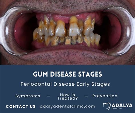 Gum Disease Long Term Care: Your Ultimate Guide to Lasting Oral Health