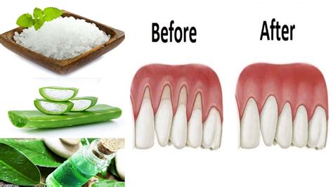 Best Natural Remedies for Gum Disease Prevention