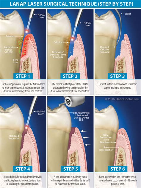 Gum Disease Step by Step: Your Clear Guide to Prevention and Treatment