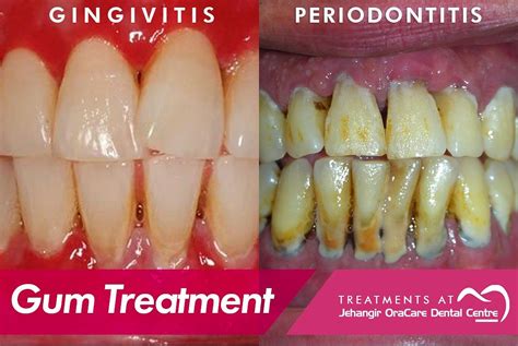 Urgent Gum Disease Treatment 24 Hour Service Available Now