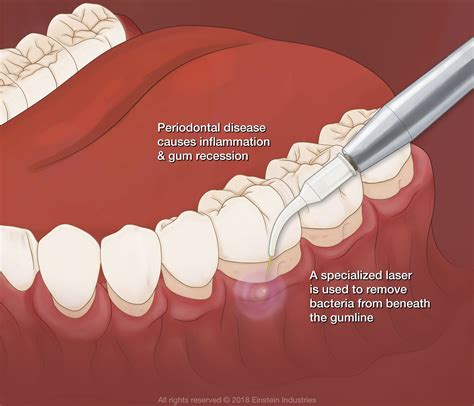 Discover Affordable Gum Disease Treatment Financing Options Today