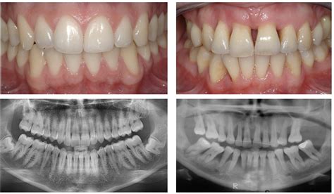 Uncovering Real-Life Success Stories in Gum Disease Treatment Results