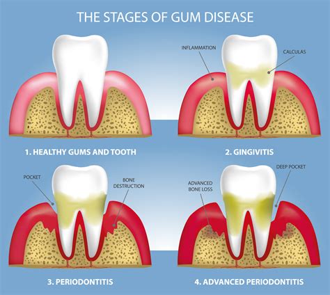 Discover Effective Gum Disease Treatment UK Options Today