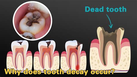 How to Improve Tooth Decay Naturally and Effectively