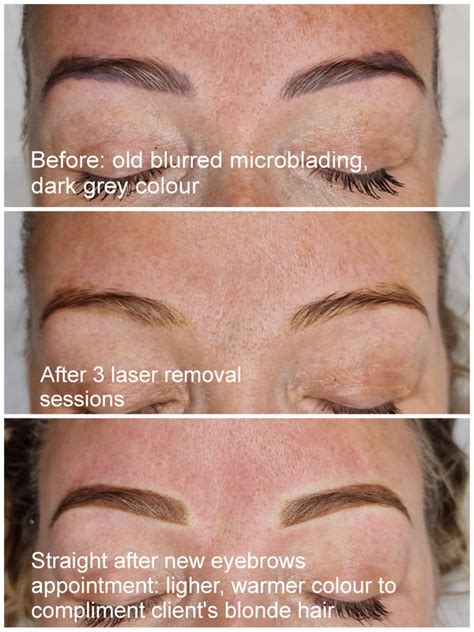 How To Remove An Eyebrow Tattoo Microblading Or Laser Micro