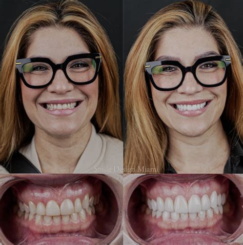 How to Manage Professional Teeth Cleaning Recovery