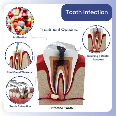Ultimate Guide to Effective How to Treat Tooth Care at Home