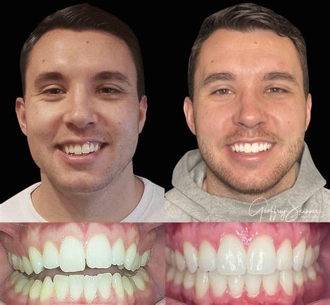 Unveiling Invisalign Treatment Before and After: Your Journey to a Perfect Smile Revealed