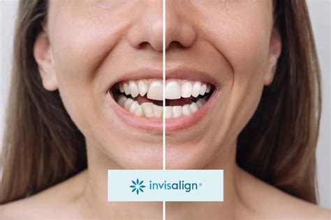 Uncover Amazing Invisalign Treatment Results You Didn't Know Possible