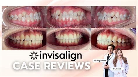 Top Invisalign Treatment Reviews: Real User Insights