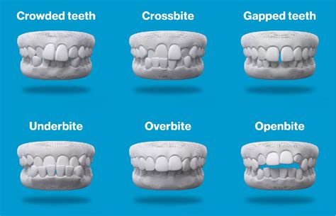 Discover the Best Invisalign Treatment Toronto Has to Offer
