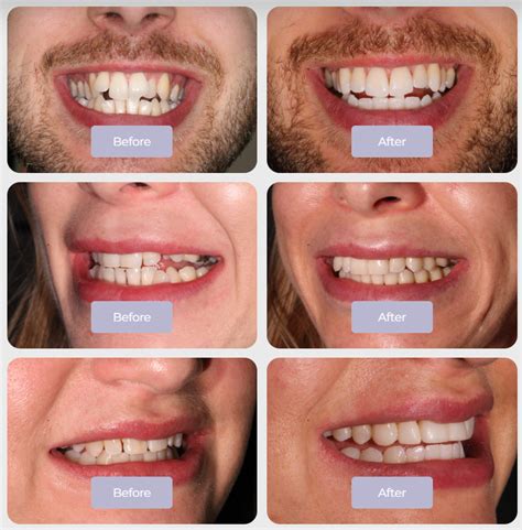Invisalign Cost: Affordable Smile Transformation