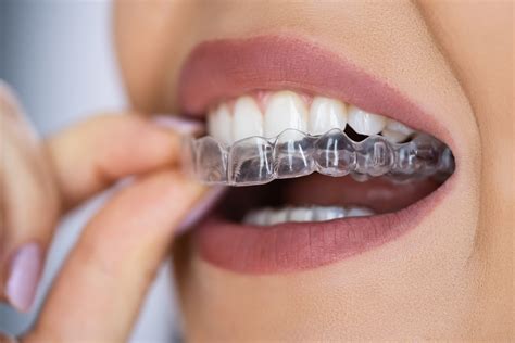 Invisible Braces 24 Hour Service Unveiled