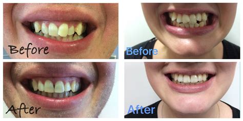 Invisible Braces Before and After Transformations