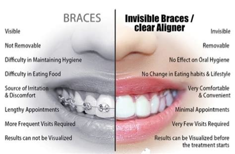 Toronto's Invisible Braces Cost Revealed