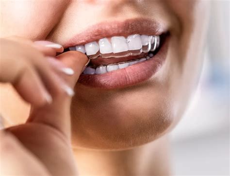 Invisible Braces Singapore: Discover Painless Teeth Alignment Solutions