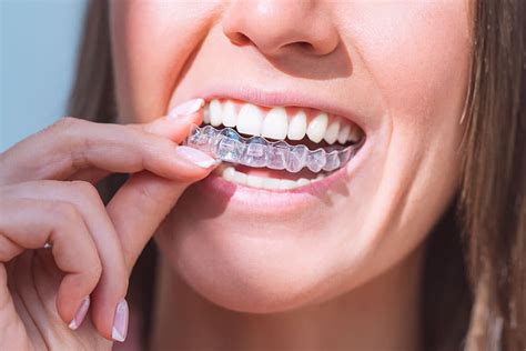 Best Invisible Braces Specialist: Transform Your Smile