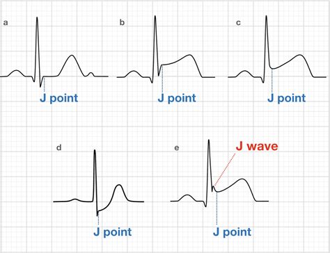 J Wave ECG Uncovered: Surprising Insights and Hidden Risks You Need to Know