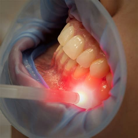 Affordable Laser Dentistry Cost in Toronto Explored