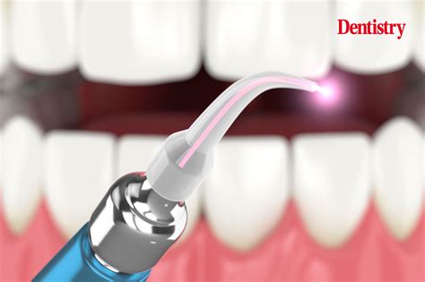 Discover Laser Dentistry UK: The Future of Painless Dental Care