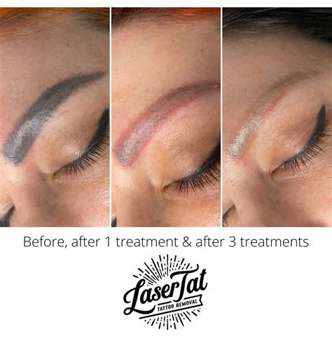 Lasertat Amp 39 S Guide To Cosmetic Eyebrow Tattoo Removal Lasertat