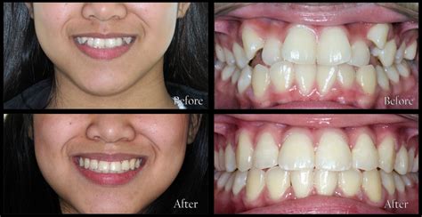 Orthodontic Treatment: Stunning Before and After Transformations