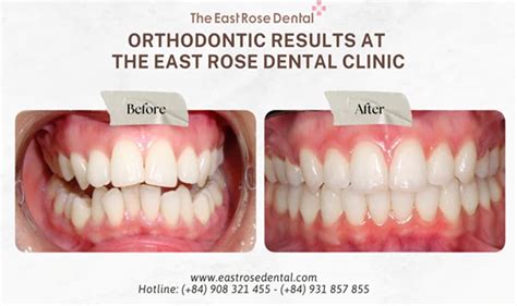 Uncover the Best Orthodontic Treatment Results: Your Ultimate Guide