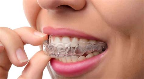 Same Day Orthodontic Treatment Availability