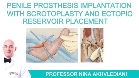 Penile Prosthesis: Before and After Transformation
