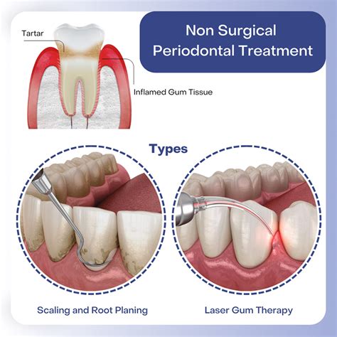 Unlock the Secrets to Perfect Oral Health with Periodontal Treatment Consultation