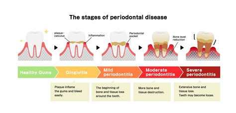 Periodontal Treatment: Quick Recovery Timeline Revealed