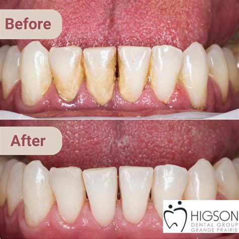 Plaque Removal Before and After: Transform Your Smile in Minutes