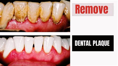 Plaque Removal Benefits Unveiled Discover Hidden Advantages
