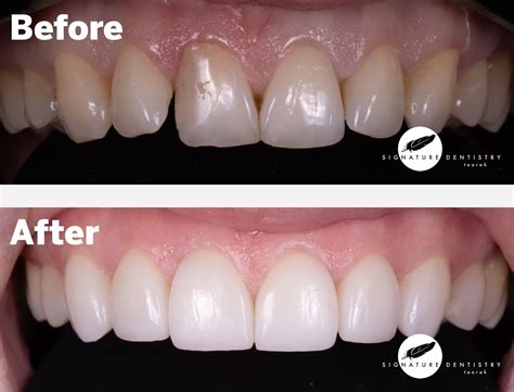 Porcelain Veneers Advanced Treatment: Transform Your Smile Today