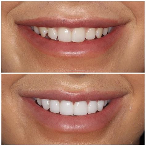 Porcelain Veneers Before and After Transformation: Real Results Revealed
