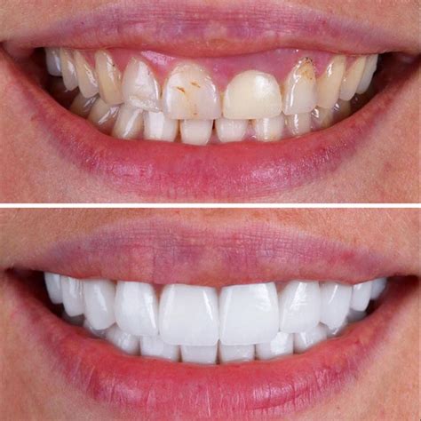Uncover porcelain veneers cost in London: Expert guide