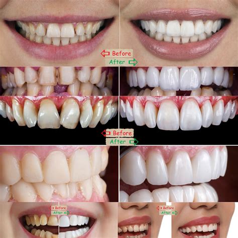 Discover Affordable Porcelain Veneers Price Options Today
