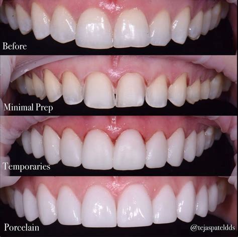 Top Porcelain Veneers Reviews: What Patients Really Think
