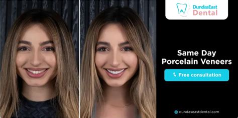 Porcelain Veneers Same Day Appointment: Achieve Smile Transformation Now