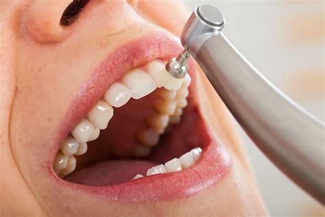 Top Best Practices for Professional Teeth Cleaning