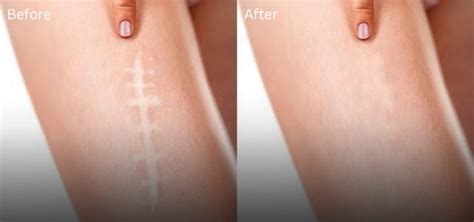 Reclaim Your Skin The Ultimate Guide To Scar Camouflage Tattoos