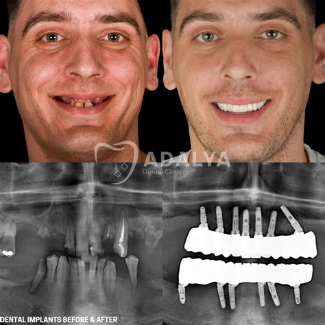 Same Day Dental Implants: Stunning Before-After Transformation