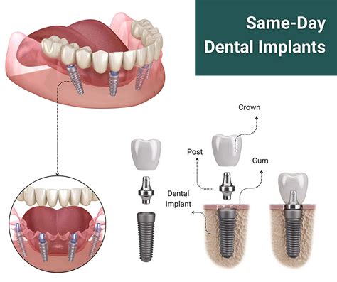 Same Day Dental Implants Consultation: Your Quick Fix to Beautiful Smiles