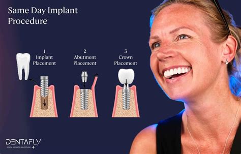 Same Day Dental Implants Cost Uncovered