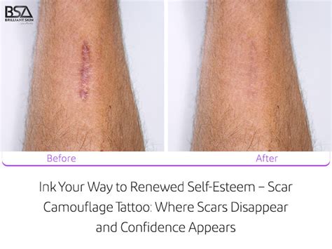 Scar Camouflage Tattoo The Dermatography Clinic