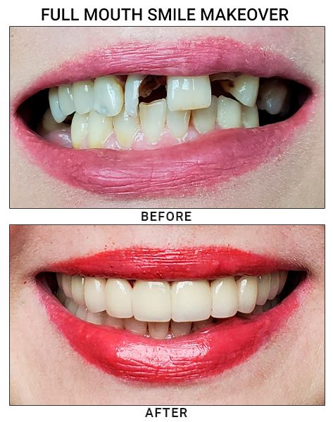 Smile Makeover Advanced Treatment Guide
