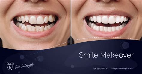 Smile Makeover Cost in UK: Discover Affordable Transformations