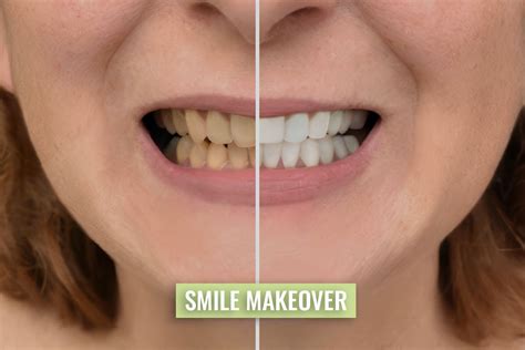 Get a Perfect Smile Makeover in London!
