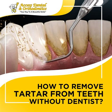 Effective Tartar Removal Tips for Healthier Teeth