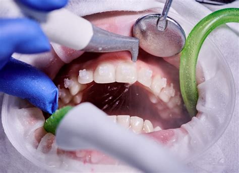 Best Teeth Cleaning Dentist Advice: Expert Tips